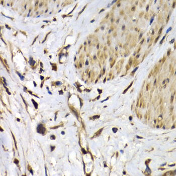 ISG15 Antibody - Immunohistochemistry of paraffin-embedded human gastric cancer using ISG15 Antibodyat dilution of 1:200 (40x lens).