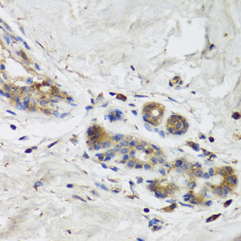 ISG15 Antibody - Immunohistochemistry of paraffin-embedded human breast cancer using ISG15 Antibodyat dilution of 1:100 (40x lens).
