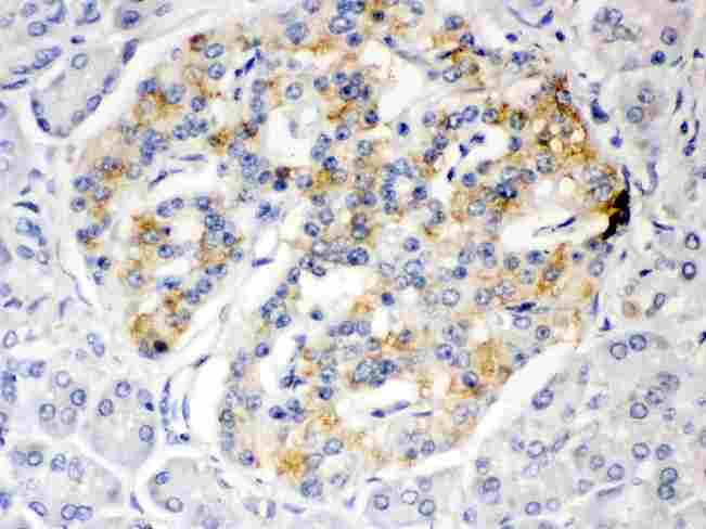 ISG15 Antibody - ISG15 was detected in paraffin-embedded sections of human pancreatic cancer tissues using rabbit anti- ISG15 Antigen Affinity purified polyclonal antibody