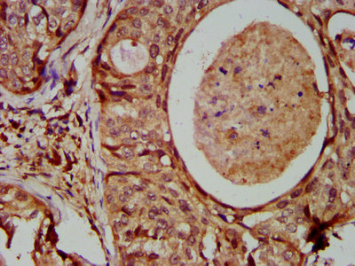 ISG54 / IFIT2 Antibody - Immunohistochemistry Dilution at 1:600 and staining in paraffin-embedded human cervical cancer performed on a Leica BondTM system. After dewaxing and hydration, antigen retrieval was mediated by high pressure in a citrate buffer (pH 6.0). Section was blocked with 10% normal Goat serum 30min at RT. Then primary antibody (1% BSA) was incubated at 4°C overnight. The primary is detected by a biotinylated Secondary antibody and visualized using an HRP conjugated SP system.