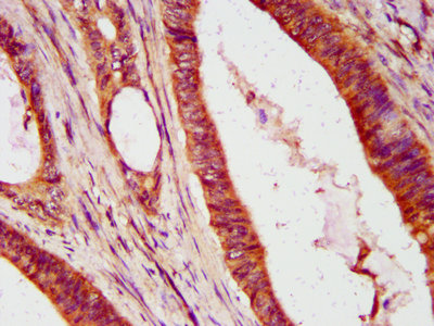 ISG54 / IFIT2 Antibody - Immunohistochemistry Dilution at 1:600 and staining in paraffin-embedded human colon cancer performed on a Leica BondTM system. After dewaxing and hydration, antigen retrieval was mediated by high pressure in a citrate buffer (pH 6.0). Section was blocked with 10% normal Goat serum 30min at RT. Then primary antibody (1% BSA) was incubated at 4°C overnight. The primary is detected by a biotinylated Secondary antibody and visualized using an HRP conjugated SP system.