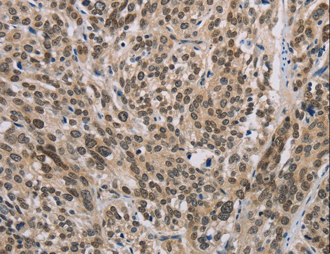 ISGF3 / IRF9 Antibody - Immunohistochemistry of paraffin-embedded Human esophagus cancer using IRF9 Polyclonal Antibody at dilution of 1:50.
