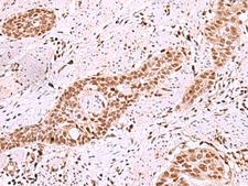 ISL2 / Islet 2 Antibody - Immunohistochemistry of paraffin-embedded Human esophagus cancer tissue  using ISL2 Polyclonal Antibody at dilution of 1:40(×200)