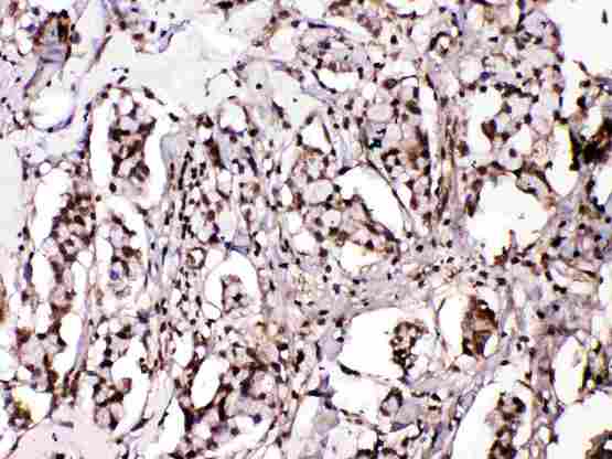 ISLET-1 / ISL1 Antibody - Islet 1 was detected in paraffin-embedded sections of human mammary cancer tissues using rabbit anti- Islet 1 Antigen Affinity purified polyclonal antibody