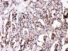ISLET-1 / ISL1 Antibody - IHC testing of FFPE human breast cancer tissue with ISL1 antibody at 1ug/ml. Required HIER: steam section in pH6 citrate buffer for 20 min and allow to cool prior to testing.