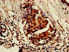 ISOC1 Antibody - Immunohistochemistry image of paraffin-embedded human breast cancer at a dilution of 1:100