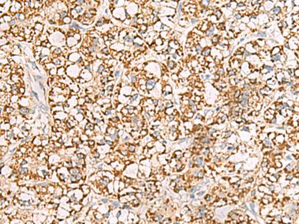 ISOC2 Antibody - Immunohistochemistry of paraffin-embedded Human liver cancer tissue  using ISOC2 Polyclonal Antibody at dilution of 1:95(×200)