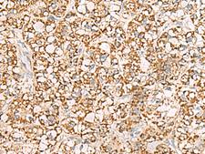 ISOC2 Antibody - Immunohistochemistry of paraffin-embedded Human liver cancer tissue  using ISOC2 Polyclonal Antibody at dilution of 1:95(×200)