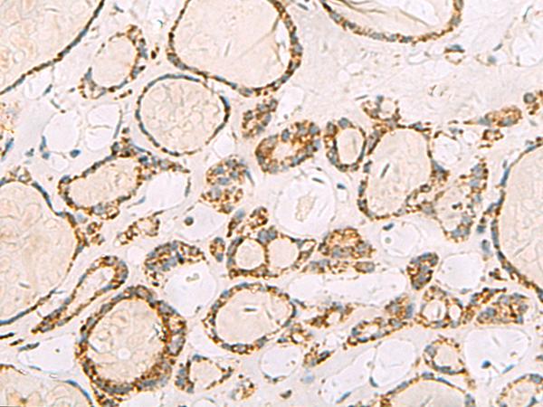 ISOC2 Antibody - Immunohistochemistry of paraffin-embedded Human thyroid cancer tissue  using ISOC2 Polyclonal Antibody at dilution of 1:95(×200)