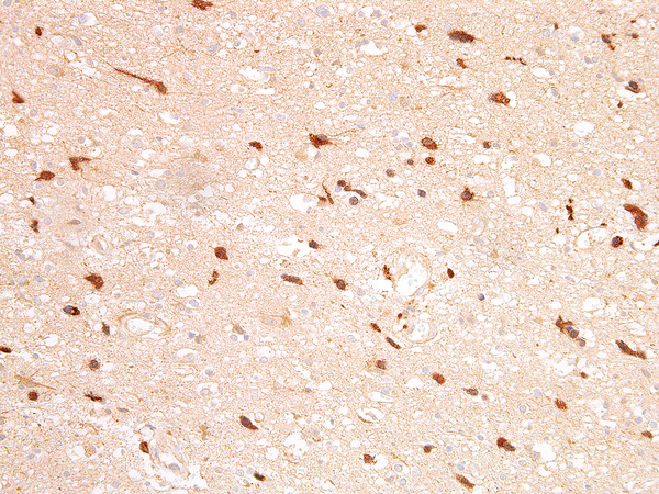 Isocitrate Dehydrogenase R132H Mutant Antibody - IDH1 R132H on Astrocytoma
