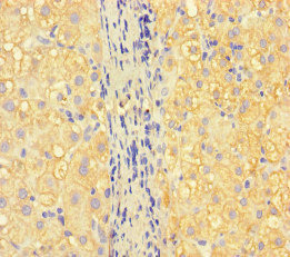 ISPD / Nip Antibody - Immunohistochemistry of paraffin-embedded human liver cancer at dilution of 1:100