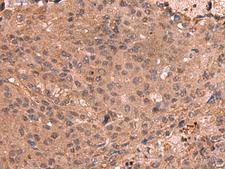 IST1 Antibody - Immunohistochemistry of paraffin-embedded Human colorectal cancer tissue  using IST1 Polyclonal Antibody at dilution of 1:40(×200)