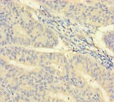 ISX Antibody - Immunohistochemistry of paraffin-embedded human endometrial cancer using ISX Antibody at dilution of 1:100