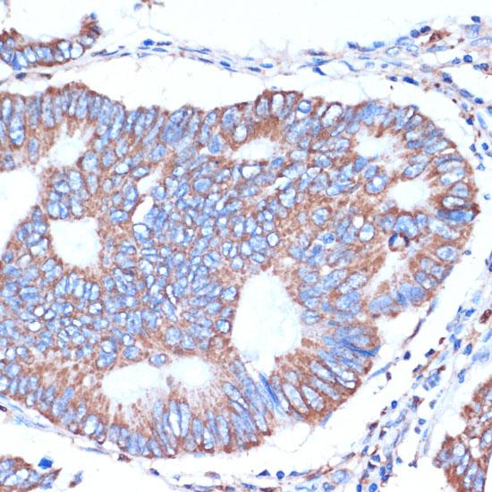 ITCH / AIP4 Antibody - Immunohistochemistry of paraffin-embedded Human colon carcinoma using ITCH Polyclonal Antibody at dilution of 1:50 (40x lens).
