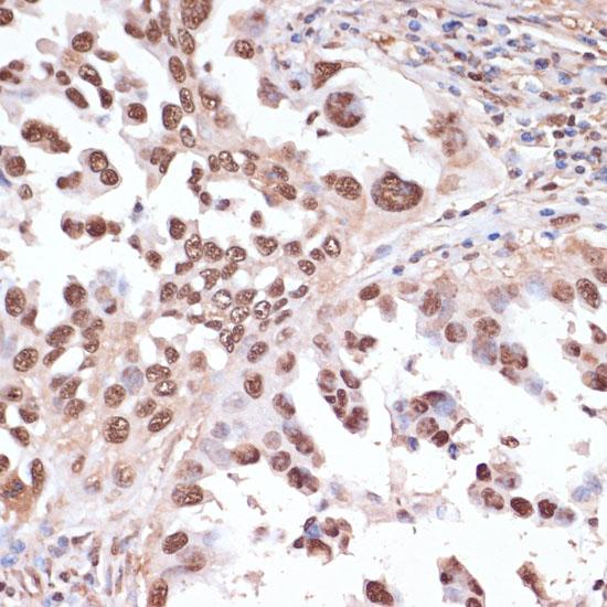ITCH / AIP4 Antibody - Immunohistochemistry of paraffin-embedded Human lung cancer using ITCH Polyclonal Antibody at dilution of 1:100 (40x lens).