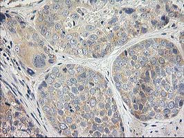 ITFG2 Antibody - IHC of paraffin-embedded Adenocarcinoma of Human breast tissue using anti-ITFG2 mouse monoclonal antibody.