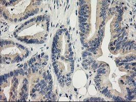 ITFG2 Antibody - IHC of paraffin-embedded Adenocarcinoma of Human colon tissue using anti-ITFG2 mouse monoclonal antibody.