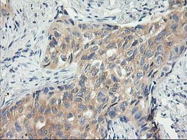 ITFG2 Antibody - IHC of paraffin-embedded Carcinoma of Human lung tissue using anti-ITFG2 mouse monoclonal antibody.