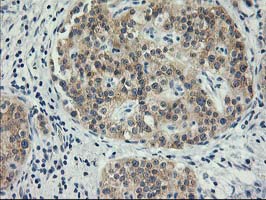 ITFG2 Antibody - IHC of paraffin-embedded Carcinoma of Human pancreas tissue using anti-ITFG2 mouse monoclonal antibody.