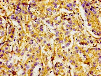ITGA1/CD49a/Integrin Alpha 1 Antibody - Immunohistochemistry image of paraffin-embedded human liver cancer at a dilution of 1:100