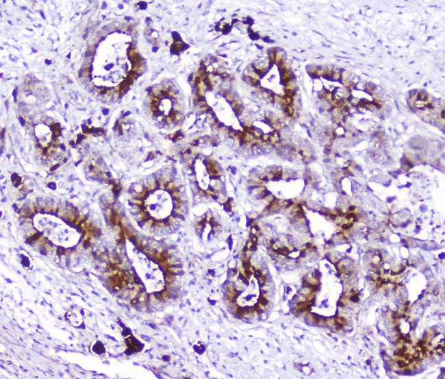 ITGA1/CD49a/Integrin Alpha 1 Antibody - IHC analysis of Integrin alpha 1 using anti-Integrin alpha 1 antibody. Integrin alpha 1 was detected in paraffin-embedded section of human cholangiocarcinoma tissue. Heat mediated antigen retrieval was performed in citrate buffer (pH6, epitope retrieval solution) for 20 mins. The tissue section was blocked with 10% goat serum. The tissue section was then incubated with 2µg/ml rabbit anti-Integrin alpha 1 Antibody overnight at 4°C. Biotinylated goat anti-rabbit IgG was used as secondary antibody and incubated for 30 minutes at 37°C. The tissue section was developed using Strepavidin-Biotin-Complex (SABC) with DAB as the chromogen.