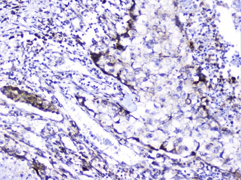 ITGA1/CD49a/Integrin Alpha 1 Antibody - IHC analysis of Integrin alpha 1 using anti-Integrin alpha 1 antibody. Integrin alpha 1 was detected in paraffin-embedded section of human lung cancer tissue. Heat mediated antigen retrieval was performed in citrate buffer (pH6, epitope retrieval solution) for 20 mins. The tissue section was blocked with 10% goat serum. The tissue section was then incubated with 2µg/ml rabbit anti-Integrin alpha 1 Antibody overnight at 4°C. Biotinylated goat anti-rabbit IgG was used as secondary antibody and incubated for 30 minutes at 37°C. The tissue section was developed using Strepavidin-Biotin-Complex (SABC) with DAB as the chromogen.