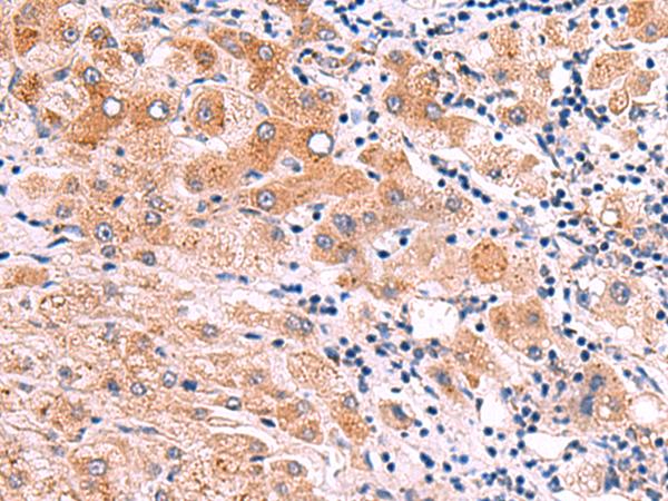 ITGA11 / Integrin Alpha 11 Antibody - Immunohistochemistry of paraffin-embedded Human liver cancer tissue  using ITGA11 Polyclonal Antibody at dilution of 1:75(×200)