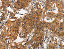 ITGA2 / CD49b Antibody - Immunohistochemistry of paraffin-embedded Human gastric cancer using ITGA2 Polyclonal Antibody at dilution of 1:30.