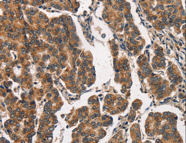 ITGA2 / CD49b Antibody - Immunohistochemistry of paraffin-embedded Human breast cancer using ITGA2 Polyclonal Antibody at dilution of 1:30.
