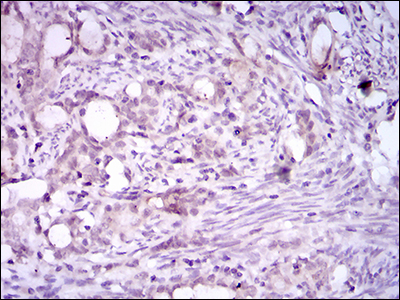 ITGA2B / CD41 Antibody - IHC of paraffin-embedded cervical cancer tissues using ITGA2B mouse monoclonal antibody with DAB staining.