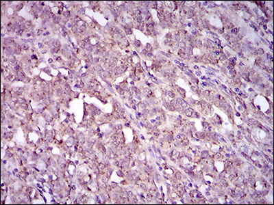 ITGA2B / CD41 Antibody - IHC of paraffin-embedded cervical cancer tissues using ITGA2B mouse monoclonal antibody with DAB staining.
