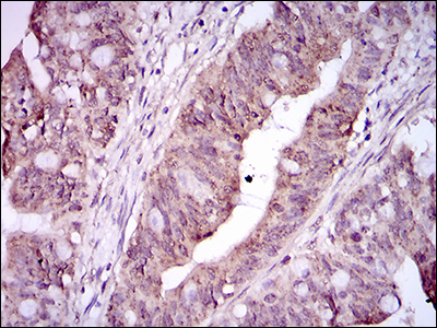 ITGA2B / CD41 Antibody - IHC of paraffin-embedded rectum cancer tissues using ITGA2B mouse monoclonal antibody with DAB staining.
