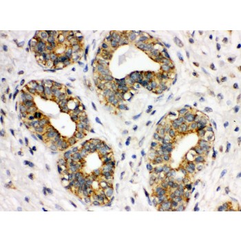 ITGA2B / CD41 Antibody - ITGA2B antibody IHC-paraffin. IHC(P): Human Mammary Cancer Tissue.