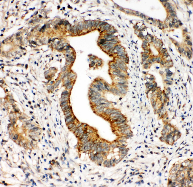 ITGA3 / CD49c Antibody - ITGA3 / CD49c antibody. IHC(P): Human Intestinal Cancer Tissue.