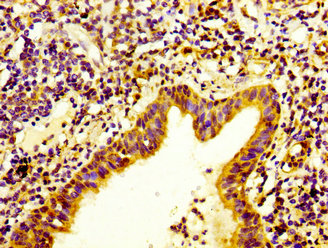 ITGA3 / CD49c Antibody - Immunohistochemistry image at a dilution of 1:400 and staining in paraffin-embedded human lung cancer performed on a Leica BondTM system. After dewaxing and hydration, antigen retrieval was mediated by high pressure in a citrate buffer (pH 6.0) . Section was blocked with 10% normal goat serum 30min at RT. Then primary antibody (1% BSA) was incubated at 4 °C overnight. The primary is detected by a biotinylated secondary antibody and visualized using an HRP conjugated SP system.