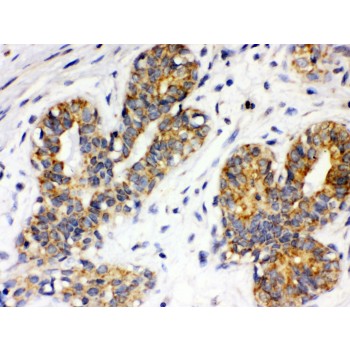 ITGA4 / VLA-4 / CD49d Antibody - Integrin alpha 4 antibody IHC-paraffin. IHC(P): Human Mammary Cancer Tissue.