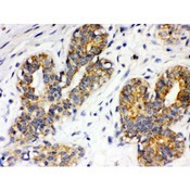 ITGA4 / VLA-4 / CD49d Antibody - Integrin alpha 4 antibody IHC-paraffin. IHC(P): Human Mammary Cancer Tissue.