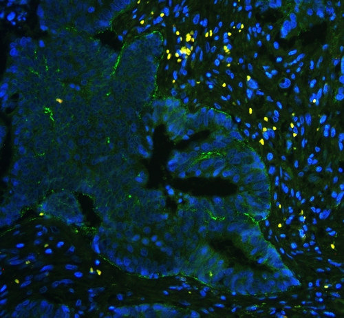 ITGA5/Integrin Alpha 5/CD49e Antibody - IF analysis of Integrin alpha 5 using anti-Integrin alpha 5 antibody Integrin alpha 5 was detected in paraffin-embedded section of human colon cancer tissues. Heat mediated antigen retrieval was performed in citrate buffer (pH6, epitope retrieval solution ) for 20 mins. The tissue section was blocked with 10% goat serum. The tissue section was then incubated with 1µg/mL rabbit anti-Integrin alpha 5 Antibody overnight at 4°C. DyLight®488 Conjugated Goat Anti-Rabbit IgG was used as secondary antibody at 1:100 dilution and incubated for 30 minutes at 37°C. The section was counterstained with DAPI. Visualize using a fluorescence microscope and filter sets appropriate for the label used.