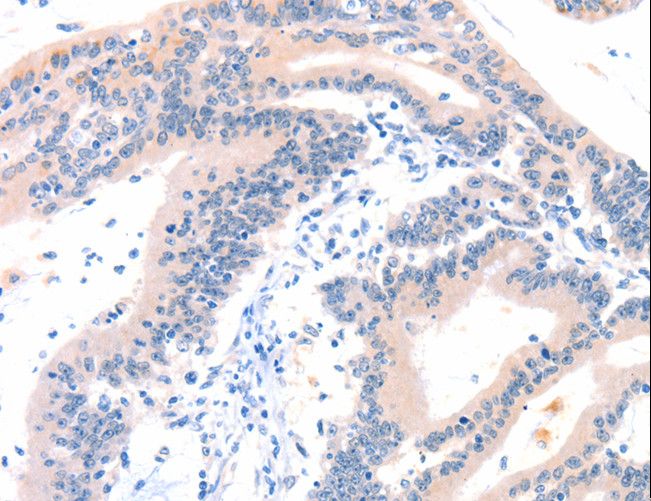 ITGA6/Integrin Alpha 6/CD49f Antibody - Immunohistochemistry of paraffin-embedded Human colon cancer using ITGA6 Polyclonal Antibody at dilution of 1:50.