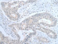 ITGA8 / Integrin Alpha 8 Antibody - Immunohistochemistry of paraffin-embedded Human colorectal cancer tissue  using ITGA8 Polyclonal Antibody at dilution of 1:30(×200)
