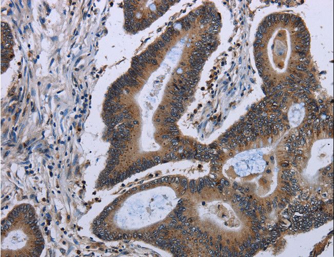 ITGAE / CD103 Antibody - Immunohistochemistry of paraffin-embedded Human colon cancer using ITGAE Polyclonal Antibody at dilution of 1:50.