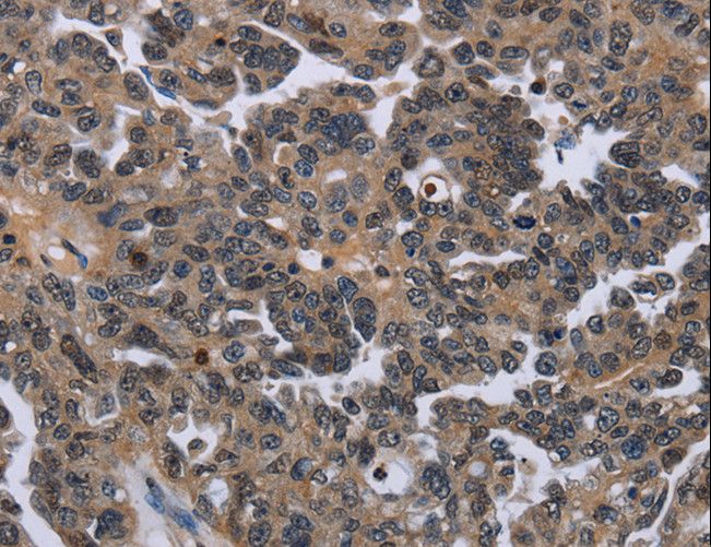 ITGAE / CD103 Antibody - Immunohistochemistry of paraffin-embedded Human ovarian cancer using ITGAE Polyclonal Antibody at dilution of 1:50.
