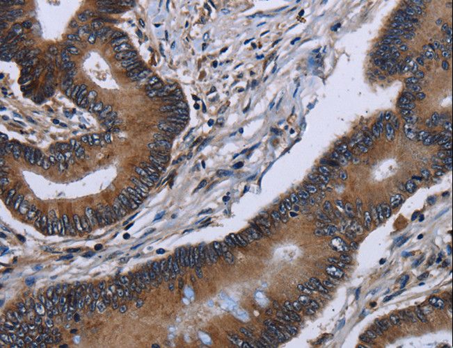 ITGAE / CD103 Antibody - Immunohistochemistry of paraffin-embedded Human lung cancer using ITGAE Polyclonal Antibody at dilution of 1:60.