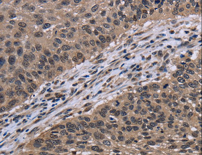 ITGAE / CD103 Antibody - Immunohistochemistry of paraffin-embedded Human lung cancer using ITGAE Polyclonal Antibody at dilution of 1:60.