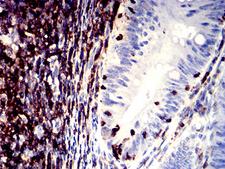 ITGAL / CD11a Antibody - Immunohistochemical analysis of paraffin-embedded rectum cancer tissues using CD11a mouse mAb with DAB staining.