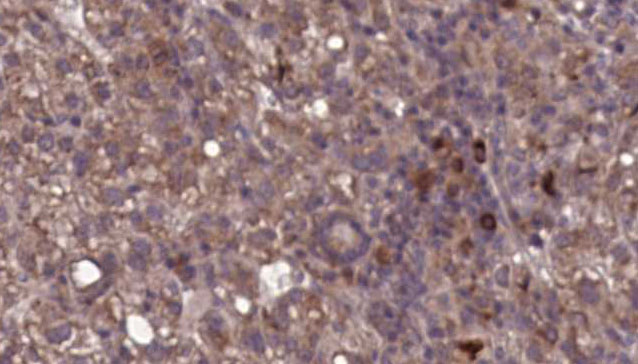 ITGAL / CD11a Antibody - 1:100 staining human liver carcinoma tissues by IHC-P. The sample was formaldehyde fixed and a heat mediated antigen retrieval step in citrate buffer was performed. The sample was then blocked and incubated with the antibody for 1.5 hours at 22°C. An HRP conjugated goat anti-rabbit antibody was used as the secondary.