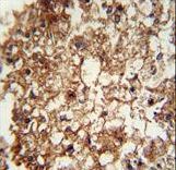 ITGAM / CD11b Antibody - CD11b antibody immunohistochemistry of formalin-fixed and paraffin-embedded human hepatocarcinoma followed by peroxidase-conjugated secondary antibody and DAB staining.
