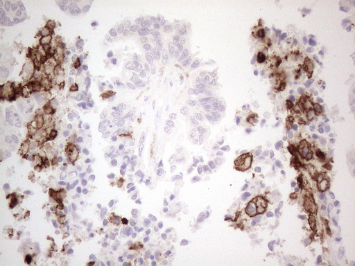 ITGAM / CD11b Antibody - Immunohistochemical staining of paraffin-embedded Adenocarcinoma of Human ovary tissue using anti-ITGAM mouse monoclonal antibody. (Heat-induced epitope retrieval by 1mM EDTA in 10mM Tris buffer. (pH8.5) at 120°C for 3 min. (1:150)