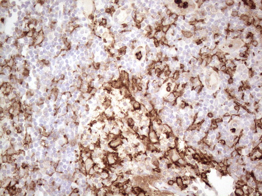 ITGAM / CD11b Antibody - Immunohistochemical staining of paraffin-embedded Carcinoma of Human thyroid tissue using anti-ITGAM mouse monoclonal antibody. (Heat-induced epitope retrieval by 1mM EDTA in 10mM Tris buffer. (pH8.5) at 120°C for 3 min. (1:150)