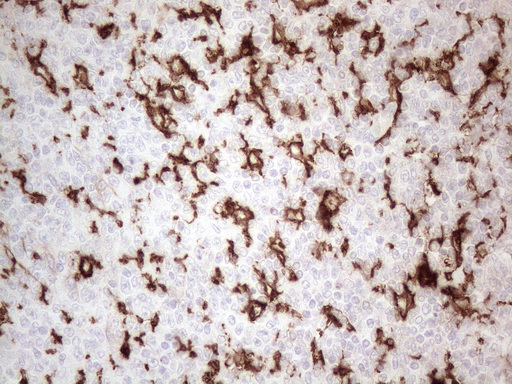 ITGAM / CD11b Antibody - Immunohistochemical staining of paraffin-embedded Human lymphoma tissue using anti-ITGAM mouse monoclonal antibody. (Heat-induced epitope retrieval by 1mM EDTA in 10mM Tris buffer. (pH8.5) at 120°C for 3 min. (1:150)